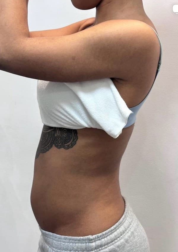 Before - Body contouring results