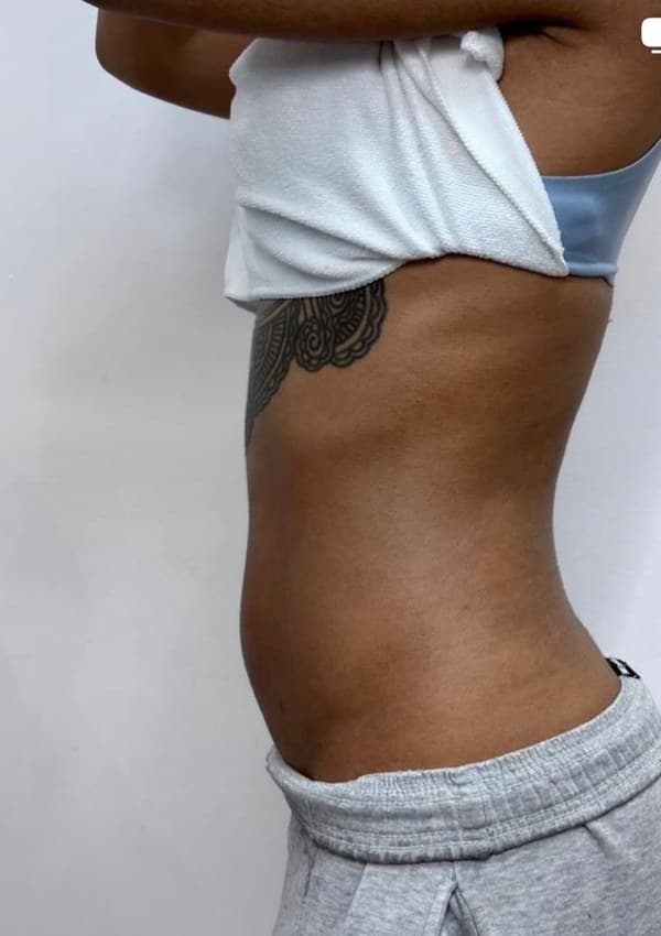 RF Face & Body at DZ Beauty Birmingham