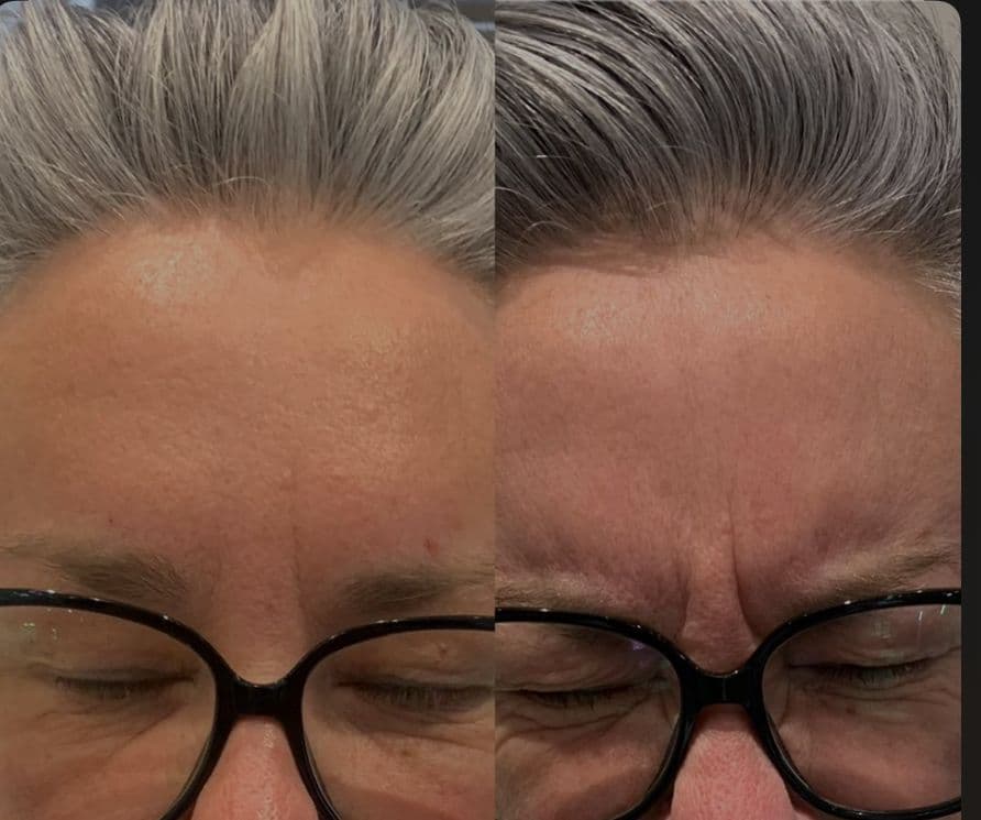 Before - Botox forehead results