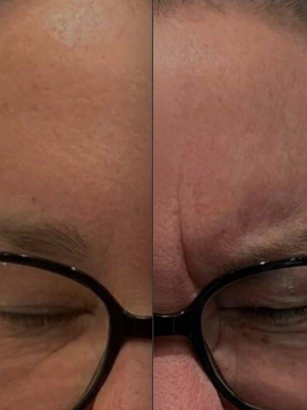 Anti-Wrinkle Injections treatments in Birmingham