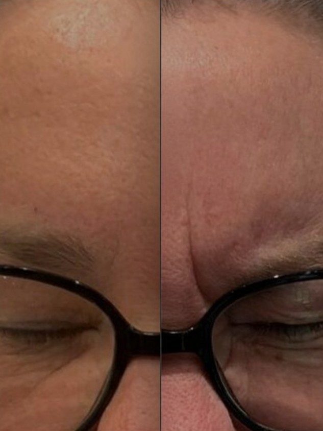 Anti-Wrinkle Injections treatments at DZ Beauty Birmingham